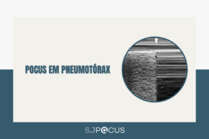 POCUS EM PNEUMOTÓRAX SJPOCUS