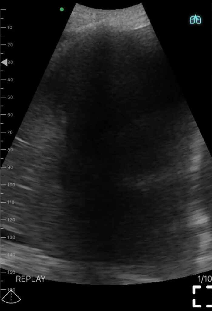 Derrame Pleural - Pocus Pulmonar - Jellyfish Sign