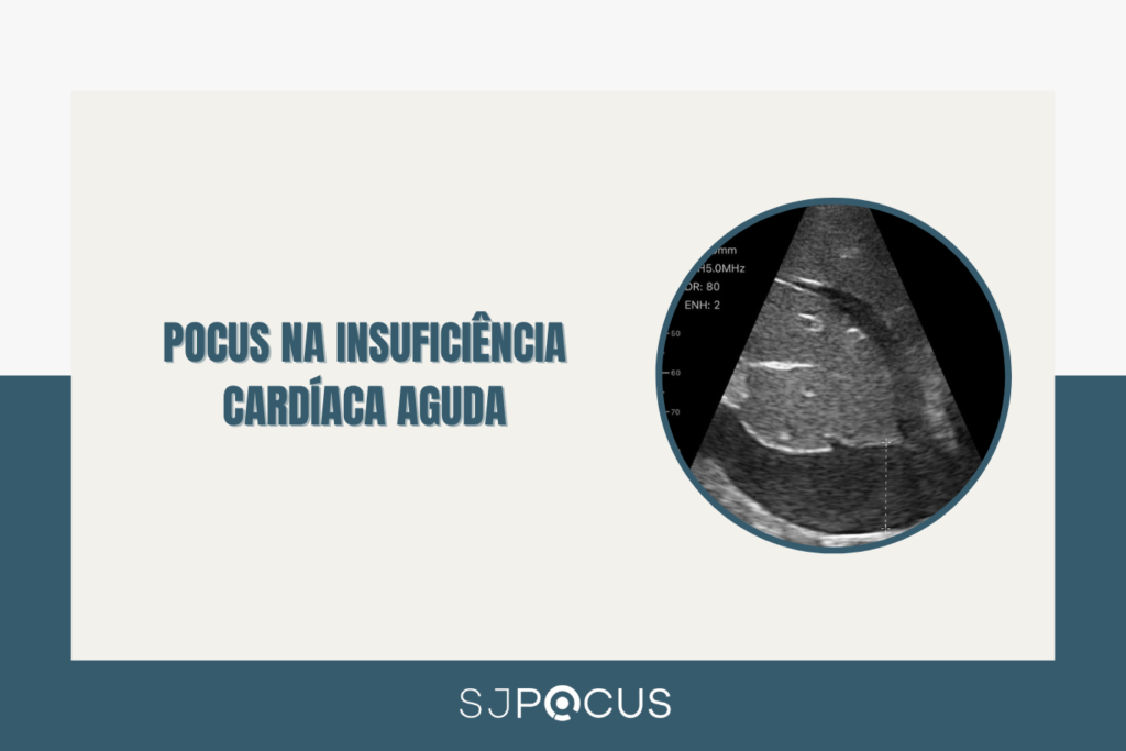 POCUS NA INSUFICIÊNCIA CARDÍACA AGUDA SJPOCUS