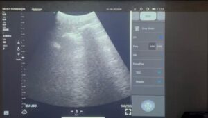 ultrassom pocus emergência sjpocus